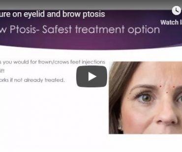 Eyelid ptosis from botox, azzalure or bocouture.