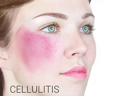 Bacterial Infection caused by Dermal Filler Complications