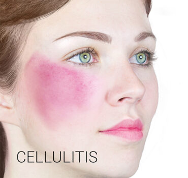 Bacterial Infection caused by Dermal Filler Complications