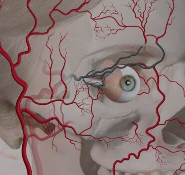 Blindness; The Worst Filler Complication