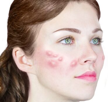Inflammatory Lesion – Diagnosis & Prevention