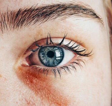 Does fear of managing tear trough complications keep you awake?