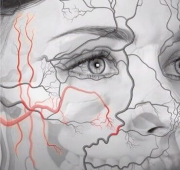 Necrosis Case Study – Cheek Filler Complications