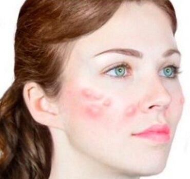Delayed onset nodules – how to diagnose & treat after dermal filler