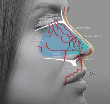 Spotting septum necrosis, severe non-surgical rhinoplasty complication