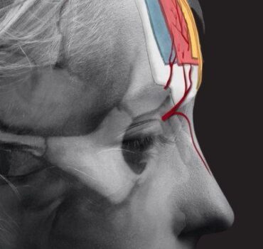 Forehead treatments: dermal fillers or BOTOX?