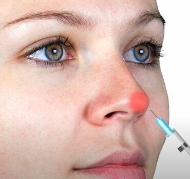 Non-surgical rhinoplasty complication: red nose tip could be pressure necrosis