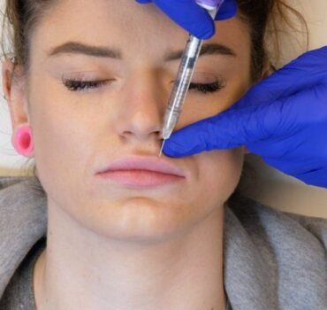 Minimal trauma lip tenting technique for lip augmentation with fillers