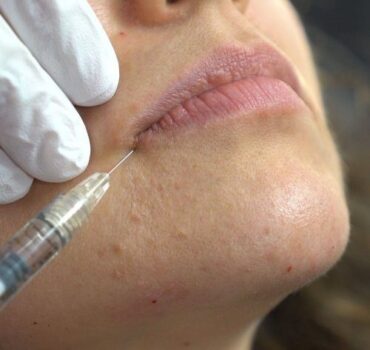 Clinical Paper Review – Comparing Vertical and Horizontal Lip Filler Injections