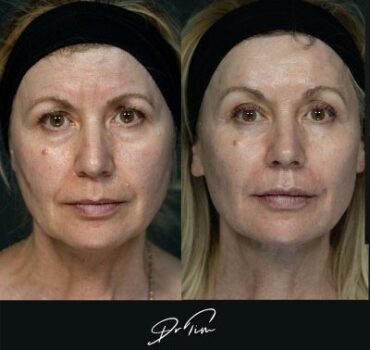 10 Negative Expressions Caused by Facial Ageing