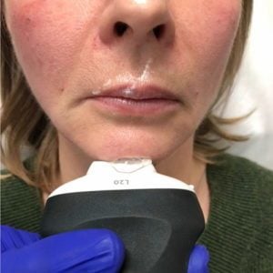 Chin Ultrasound Dermal Filler Complications