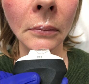 Chin anatomy and safe augmentation injection techniques