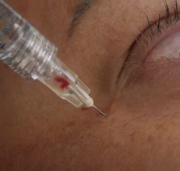 Dermal filler injections: is aspirating dangerous?