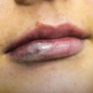 Things to Avoid after Lip Injections – The Dos & Don'ts of Lip Injections -  Dr Hunt - Edgecliff NSW