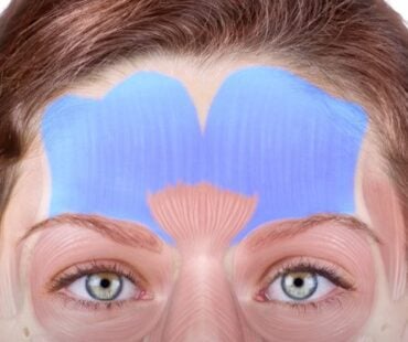 How to Treat Forehead Lines with Botox Without Freezing Facial Expression