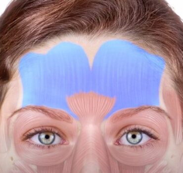 How to Treat Forehead Lines with Botox Without Freezing Facial Expression