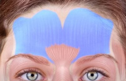 How to Treat Forehead Lines with Botox Without Freezing Facial Expression