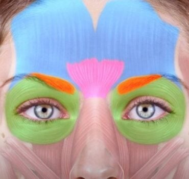 When Botox isn’t enough, when to use filler for DEEP forehead lines