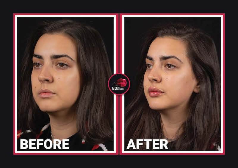 8d lip design before and after