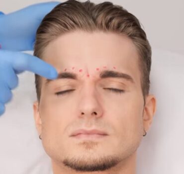 Male Botox injection patterns: forehead, frown lines and crow’s feet
