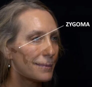 Injecting the zygoma: safety advice and injection points