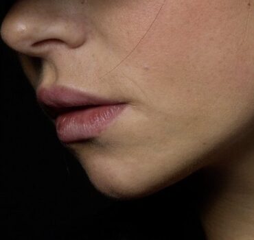 Creating a defined female jawline with fillers without masculinising