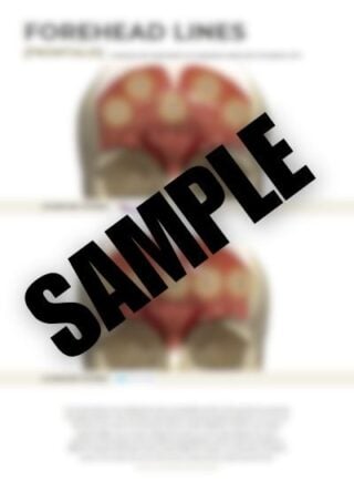 26-Essential-Botulinum-Toxin-Injection-Patterns-Forehead 26-botox-patterns-forehead-lines-sample