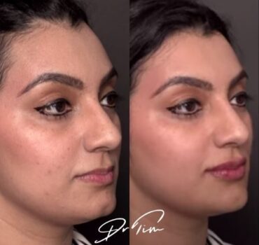 Why GOOD Facial Filler Goes Undetected