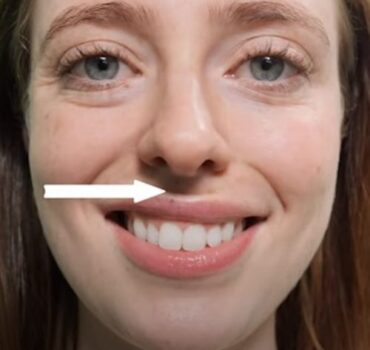 How to treat a second smile line with Botox and dermal filler