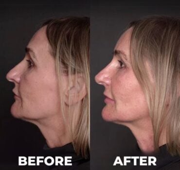 Tutorial: Safely fixing nose asymmetry with fillers (liquid rhinoplasty)