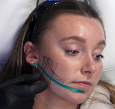 Safety First Masseter Injection Technique