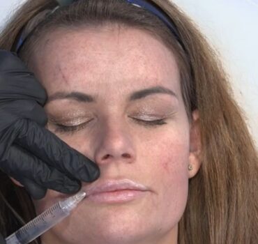 The Missing Skills in Lip Filler Training: Why Technical Knowledge Isn’t Enough