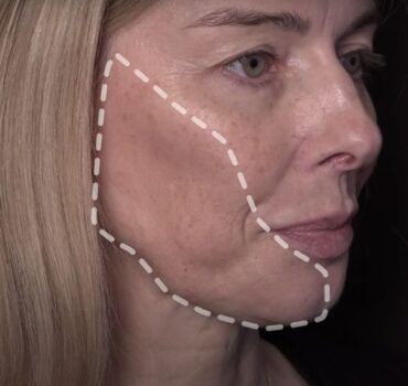 How To Minimise Jowls For Your Patients Using Dermal Filler