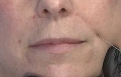 The Hidden Risk of Parallel Injections