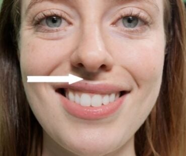 How to Treat the Horizontal Lip Crease