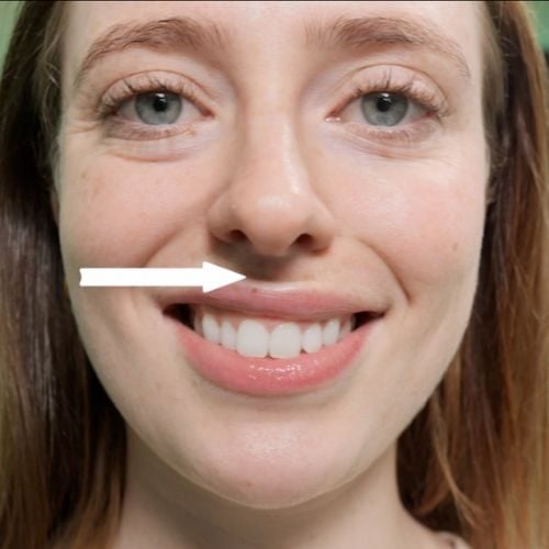 How to Treat the Horizontal Lip Crease