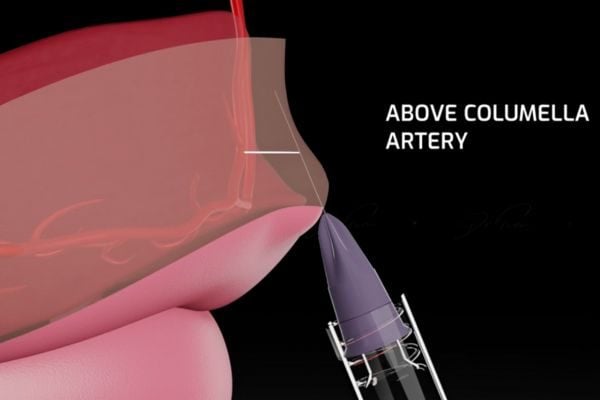 3D anatomical illustration showing needle placement above columella artery for safe lip filler injection technique