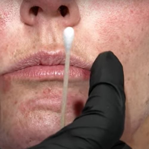 lip filler assessment