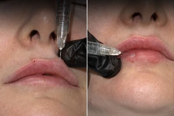 lip filler injecting technique