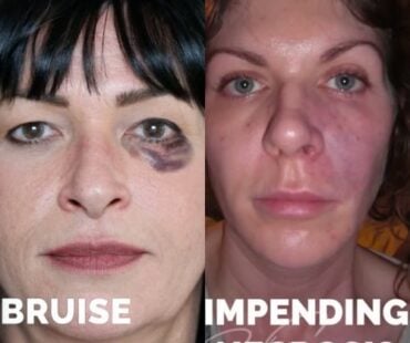 Multiple Causes of Vascular Occlusion and Necrosis