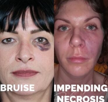 Multiple Causes of Vascular Occlusion and Necrosis
