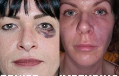 Multiple Causes of Vascular Occlusion and Necrosis