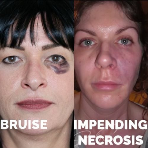 Multiple Causes of Vascular Occlusion and Necrosis