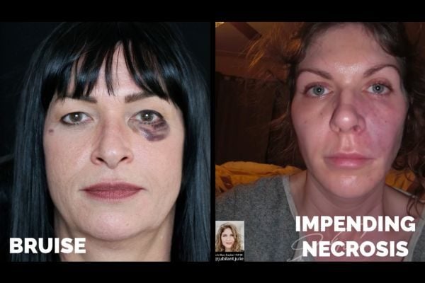Side-by-side clinical photos comparing normal bruising versus impending necrosis after dermal filler injection