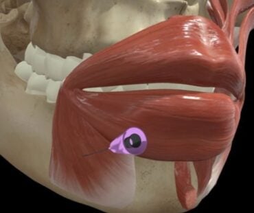 Depressor Anguli Oris (DAO) Treatment: How Relaxing This Muscle Lifts the Lower Face