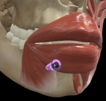 Depressor Anguli Oris (DAO) Treatment: How Relaxing This Muscle Lifts the Lower Face
