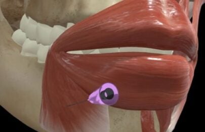 Depressor Anguli Oris (DAO) Treatment: How Relaxing This Muscle Lifts the Lower Face