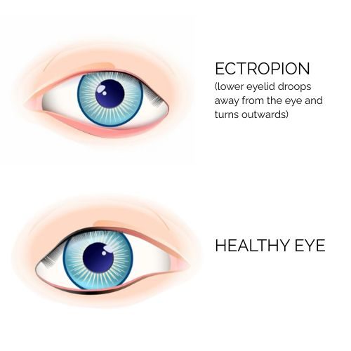Ectropion eye condition comparison showing healthy eye versus lower eyelid drooping complication