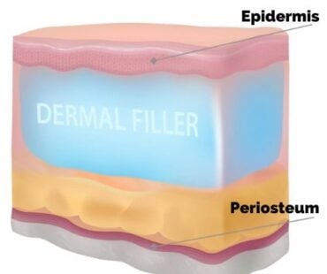 Necrosis After Fillers – 5-Goal Safety Framework