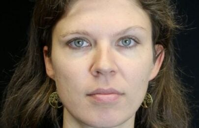 Temple Filler Brow Drop: Cannula Complications